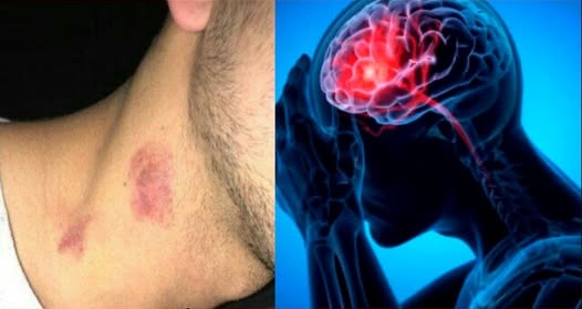 Death from ‘Love Bite’! Hickey given by lover takes teenager’s life