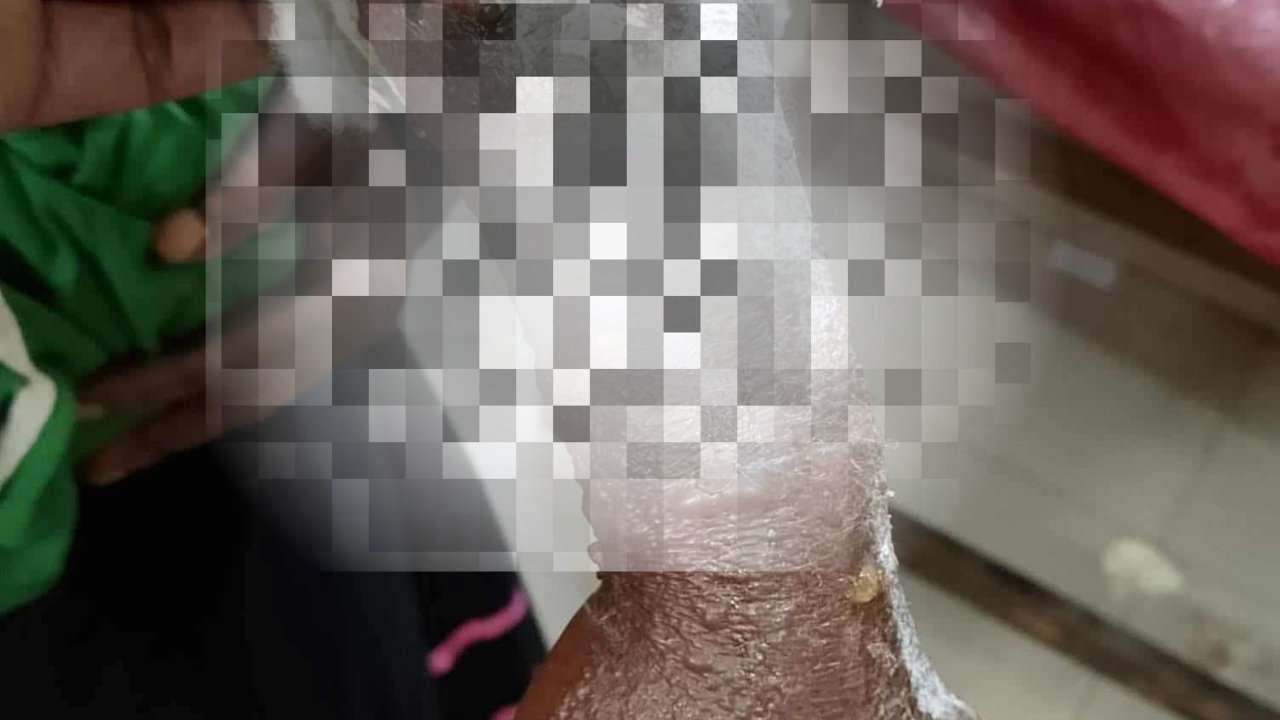 হাতুড়ে কবিরাজের ভুল চিকিৎসায় ৪ বছরের শিশুর হাত ঝুঁকিতে, উন্নত চিকিৎসার পরামর্শ