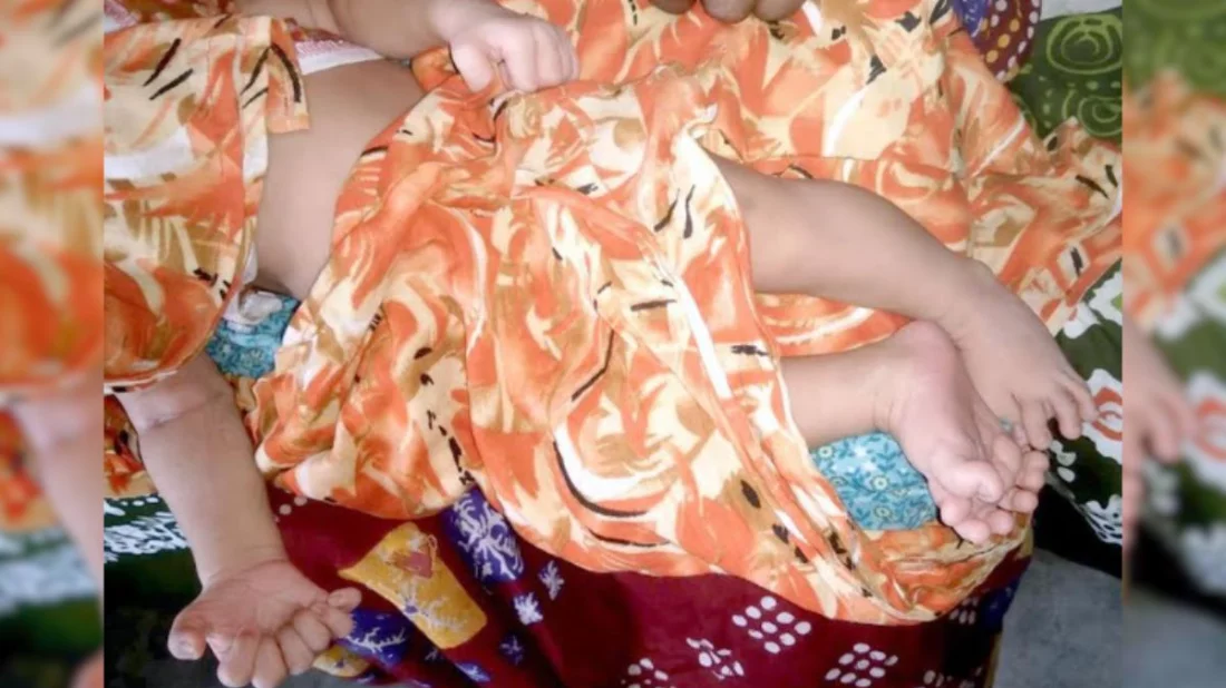 Baby Girl Born with 28 Digits in Phulbari